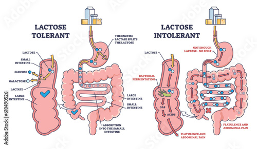 Lactose intolerance and tolerance medical process differences outline diagram. Labeled educational anatomical digestive tract splitting explanation with dairy milk allergy problem vector illustration photo