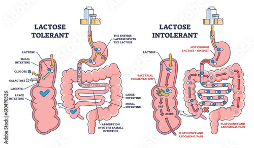Lactose intolerance and tolerance medical process differences outline diagram. Labeled educational anatomical digestive tract splitting explanation with dairy milk allergy problem vector illustration