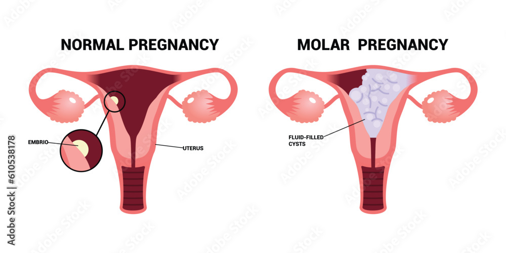 Molar pregnancy or Hydatidiform mole trophoblasts disease ectopic fetus