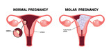 Molar pregnancy or Hydatidiform mole trophoblasts disease ectopic fetus placenta complete partial fluid filled cysts  