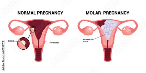 Molar pregnancy or Hydatidiform mole trophoblasts disease ectopic fetus placenta complete partial fluid filled cysts  
