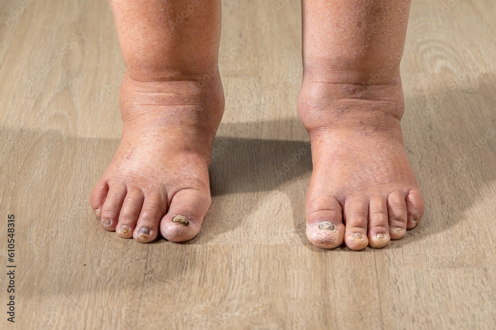 Cancer chemotherapy cause swelling of ankles (ankle oedema) , . skin to become dry, dark or peel and nails brittle or flaky. Cancer chemotherapy cause swelling of ankles (ankle oedema) , . skin to become dry, dark or peel and nails brittle or flaky.