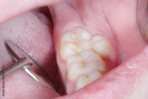 Supernumerary tooth in the mandible of the mouth. An underdone premolar. Close-up photo in dentist office. Dental examination of the patient with dental mirror.
