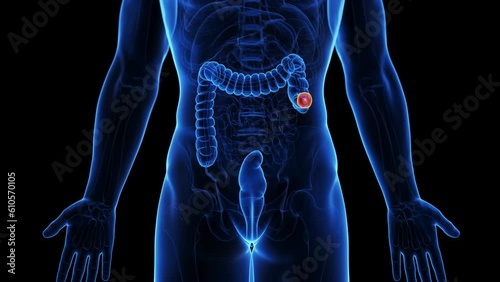 Animation of a colectomy