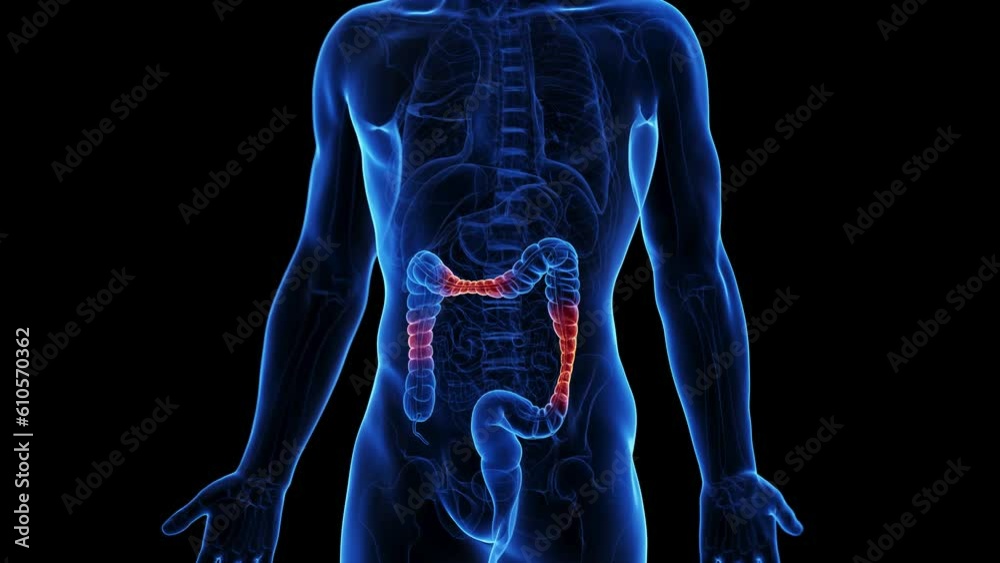 Animation of irritable bowel syndrome