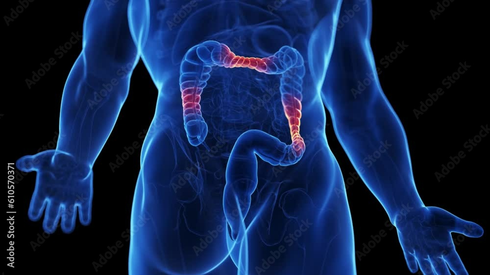 Animation of irritable bowel syndrome