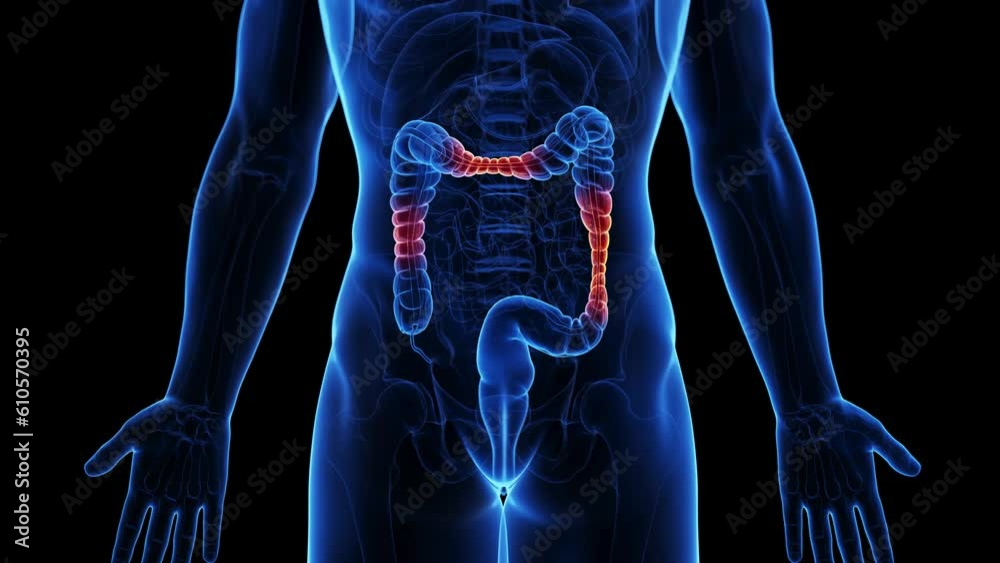 Animation of irritable bowel syndrome