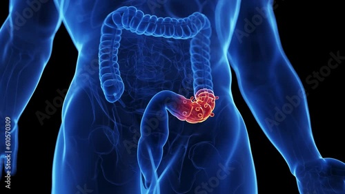 Animation of a man suffering from diverticulitis