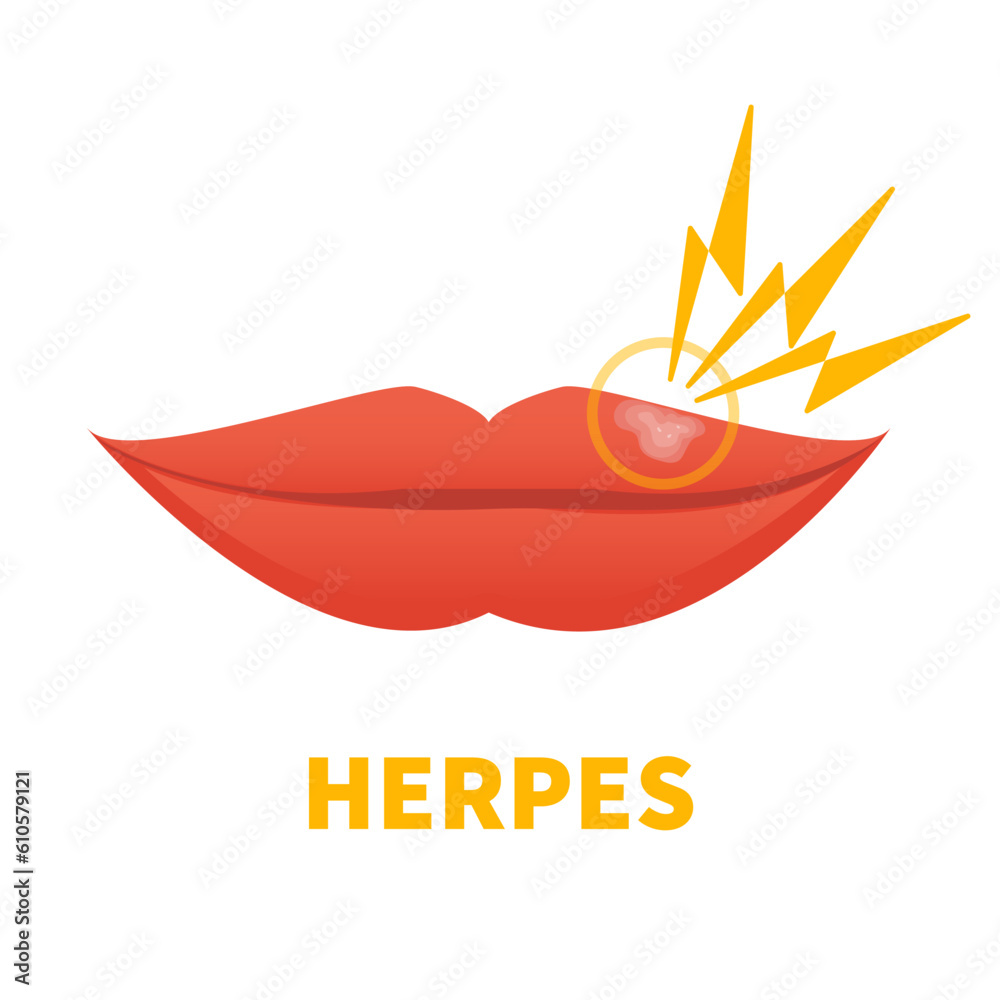 Herpes Simplex Virus on lips. Cold sore outbreak. Oral disease