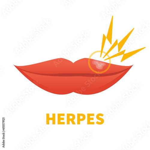 Herpes Simplex Virus on lips. Cold sore outbreak. Oral disease. Herpetic lesions treatment. Medical concept. Vector illustration isolated on white.