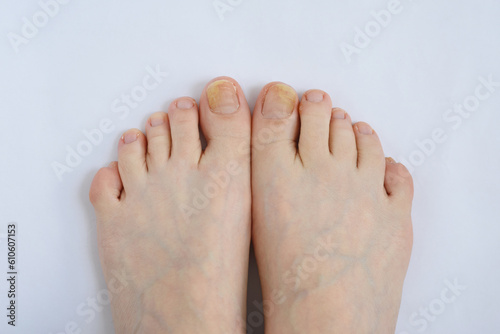 Toenails affected by fungal infection. Onychomycosis