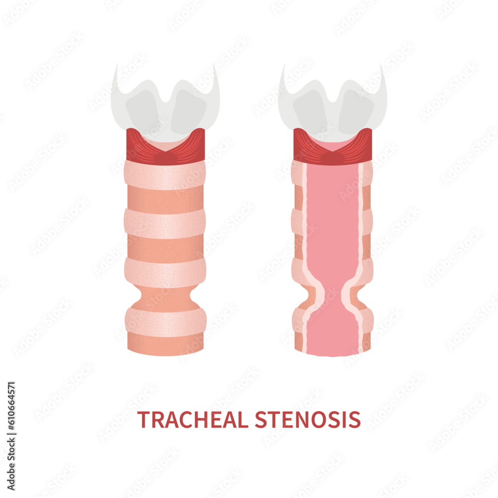 Tracheal stenosis awareness illustration. Trachea narrowing symbol