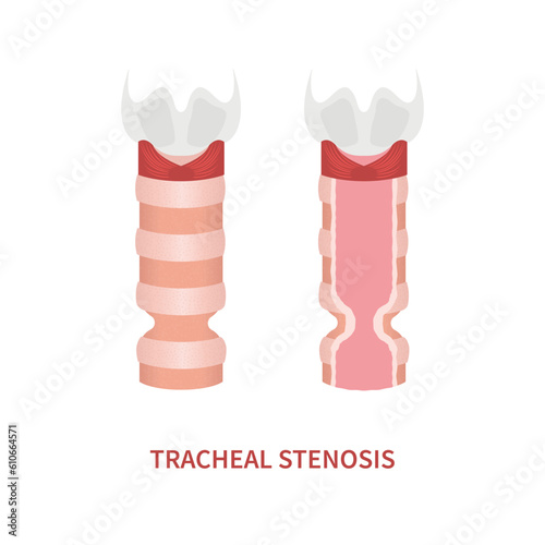 Tracheal stenosis awareness illustration. Trachea narrowing symbol. Difficulty breathing, hoarseness and voice change symptoms. Healthcare concept. Isolated flat vector illustration.
