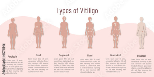 Types of vitiligo .silhouette and on it marked affected area with a lighter shade.space for text on light background.