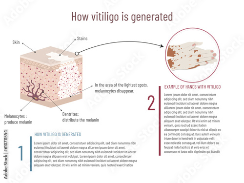 Infographic of the origin of vitiligo and visual example on the hands, skin structure and affected area on white background. photo