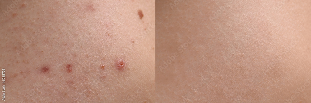 Fototapeta premium Collage with photos of person suffering from acne before and after treatment, closeup. Banner design showing affected and healthy skin