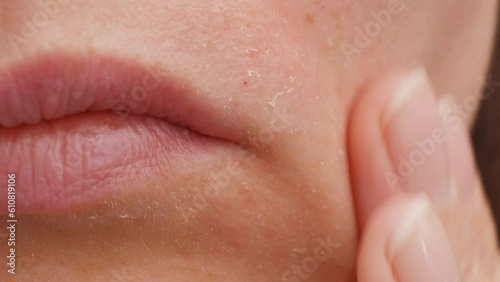 A young Caucasian woman rubs her face next to her lips with her hands. Close-up. Peeling skin after solarium