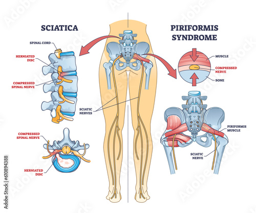 Sciatica vs piriformis medical muscle conditions comparison outline diagram. Labeled educational scheme with hip anatomy and compressed nerve or herniated disc caused acute pain vector illustration.
