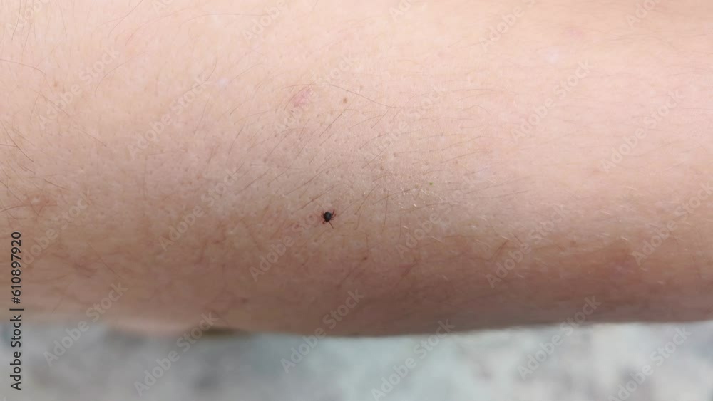 A small tick crawls over the human body on the skin. Seasonal problem of dangerous pathogens