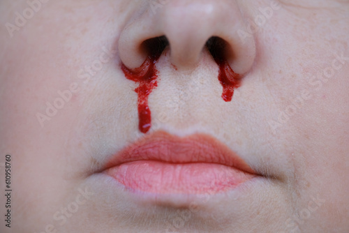Картината върху платно bright red blood flows from nostril, bright red blood flows from nostril, close-