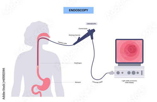 Gastroscopy endoscopy procedure