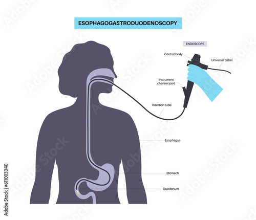 Gastroscopy endoscopy procedure