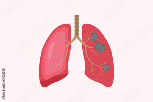 lung cancer and normal lung illustration comparation. health and unhealth lug. eps 10.  icon set photo