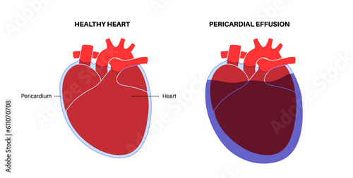 Pericardial effusion heart photo