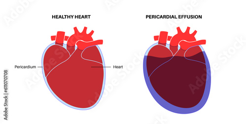 Pericardial effusion heart