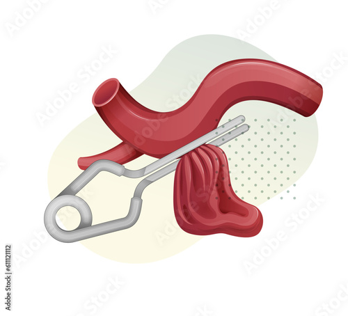 Aneurysm with Vascular Clip Procedure - Stock Illustration