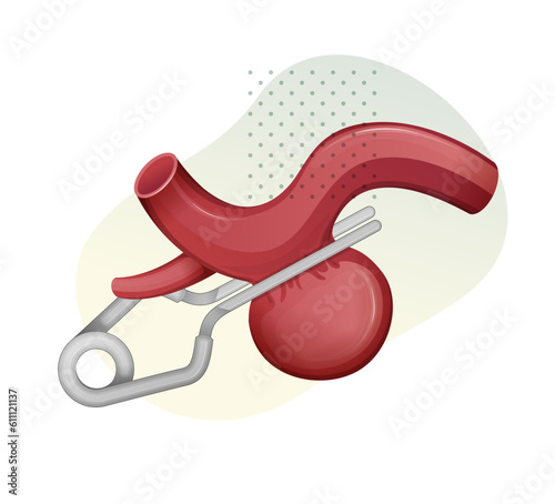 Aneurysm with Vascular Clip Procedure - Stock Illustration