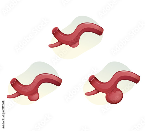 Aneurysm buildup over a period of time - Stock Illustration