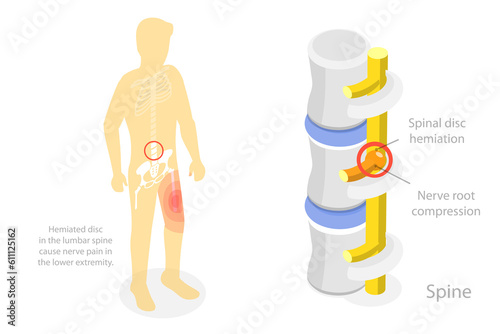 3D Isometric Flat  Conceptual Illustration of Sciatica Nerve Pain photo