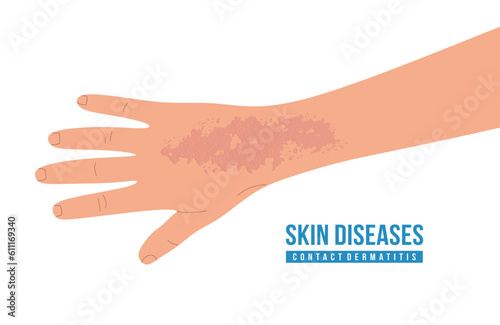 Skin diseases, contact dermatitis. Hand with scratches. Concept of healthcare and medicine. Skin irritation Flat vector illustration