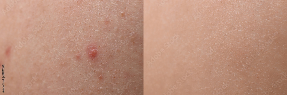 Fototapeta premium Collage with photos of person suffering from acne before and after treatment, closeup. Banner design showing affected and healthy skin