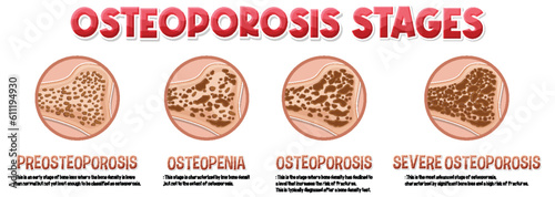 Informative poster of Osteoporosis human bone