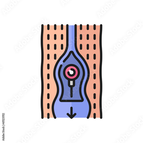 Abnormal blood flow, thrombosis and cardiovascular disease color outline icon. Vector varicose vein not closed damaged valve, blood flowing in both directions