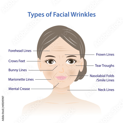Types of facial wrinkles vector illustration isolated on white background. Forehead, Bunny, Marionette, Frown lines, Mental crease, Crows feet, Tear troughs, Nasolabial folds, Smile and Neck lines.