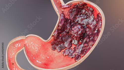 Stomach cancer. stages tumor growth in digestive system, Peptic Ulcer, Cancer attacking cell. gastric disease concept. symptoms, malignant cancerous, viruses and bacteria, Cross section, 3d render photo