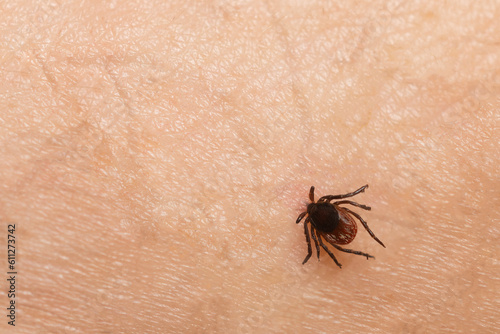Tick bite on a person's skin