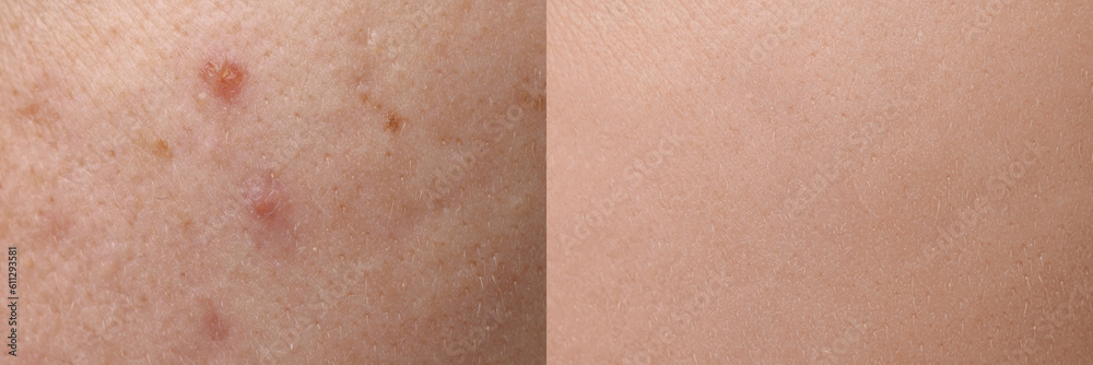 Fototapeta premium Collage with photos of person suffering from acne before and after treatment, closeup. Banner design showing affected and healthy skin