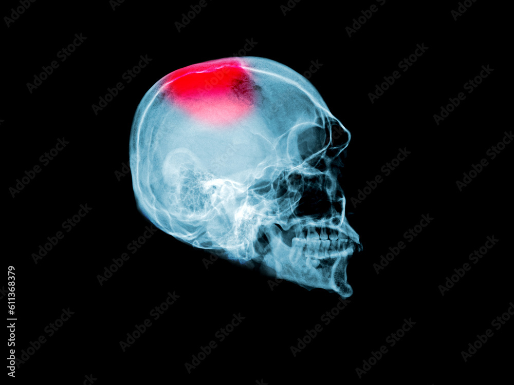 Stroke (cerebrovascular accident) 