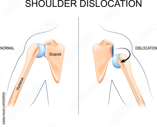 Shoulder dislocation. humerus bone trauma,