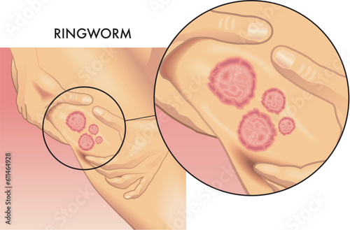 Medical illustration of a female leg affected by ringworm, with magnified detail