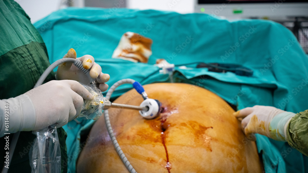 Fototapeta premium Obesity surgery. Weight loss surgery with laparoscopy technique.