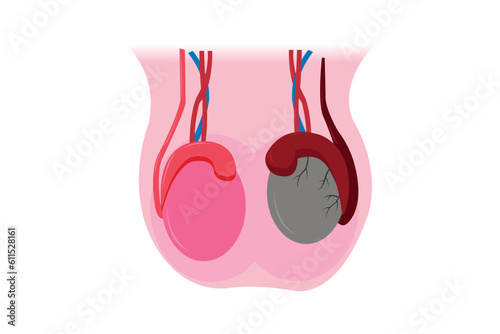 illustration of epididimitis (inflamasi epididimis). Epididymitis is inflammation of the epididymis which is generally caused by a bacterial infection. eps 10 photo