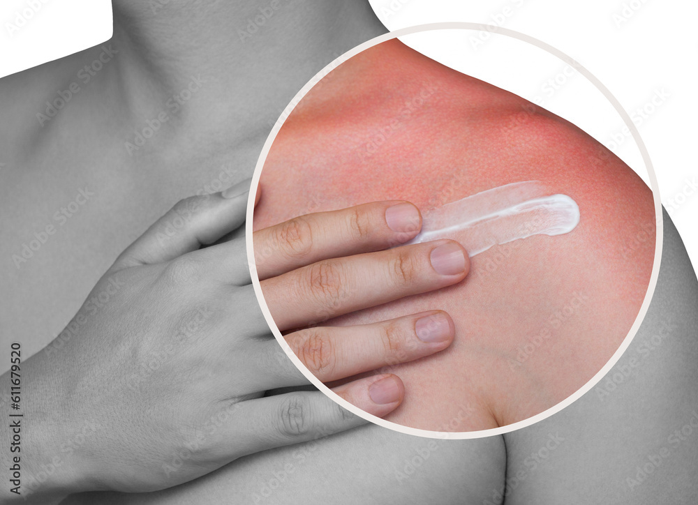 A man with reddened, itchy skin after sunburn applies a cream on the