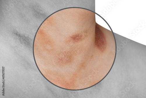 One person with Pityriasis rosea disease on the chest and neck on an isolated background photo