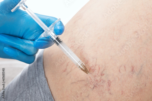 doctor shows  the dilation of small blood vessels of the skin on the leg. Medical inspection and treatment of Telangiectasia. sclerotherapy procedure photo