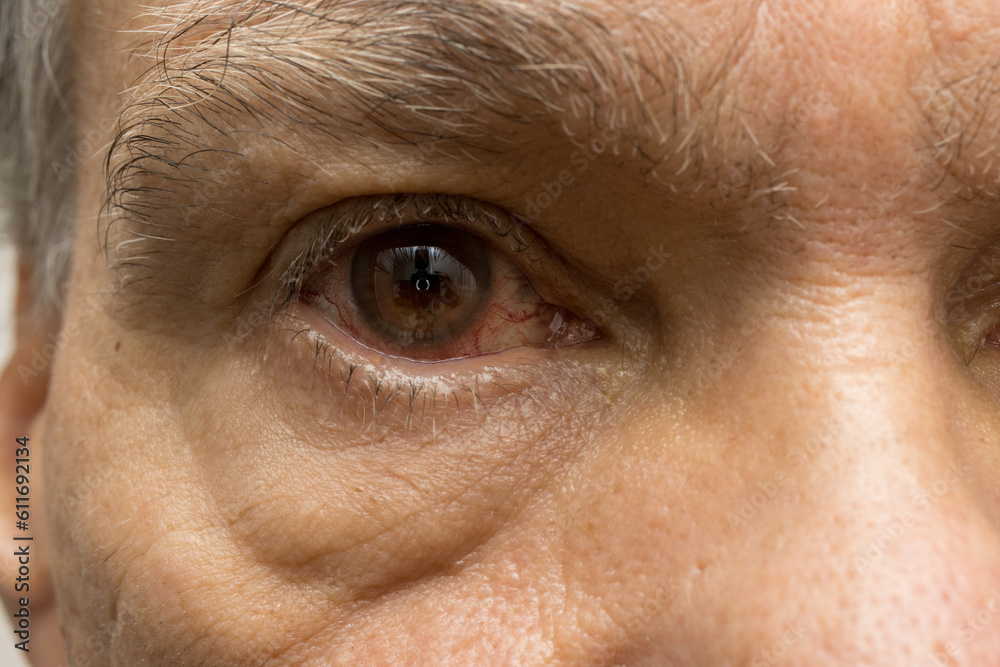 Senior Man with a pink eye infection in one of his eyes Senior Man with a pink eye infection in one of his eyes